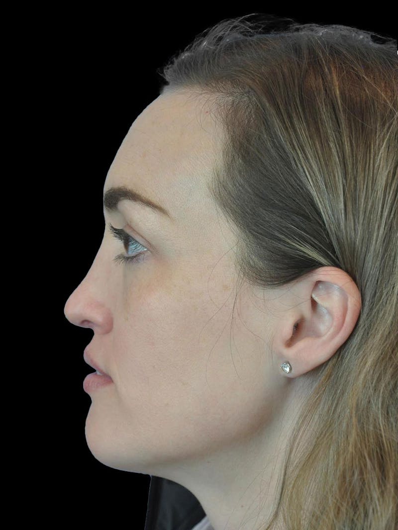 Rhinoplasty Before & After Gallery - Patient 778116 - Image 6