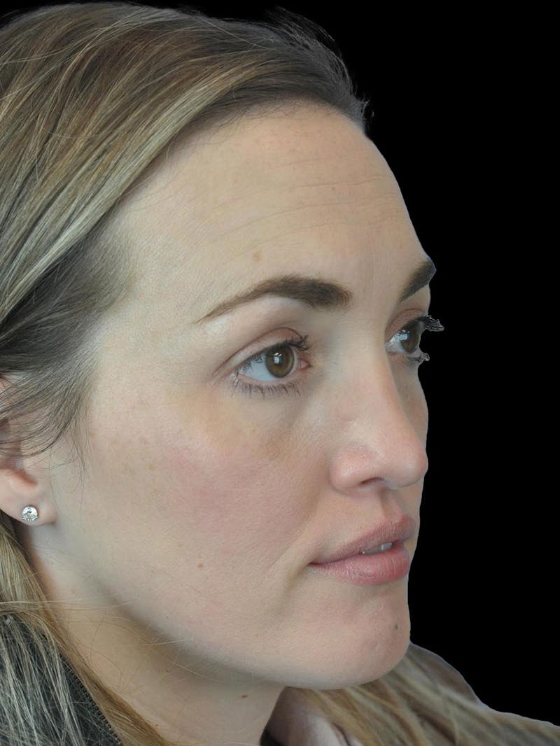 Rhinoplasty Before & After Gallery - Patient 778116 - Image 8