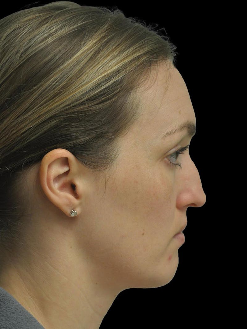 Rhinoplasty Before & After Gallery - Patient 778116 - Image 9