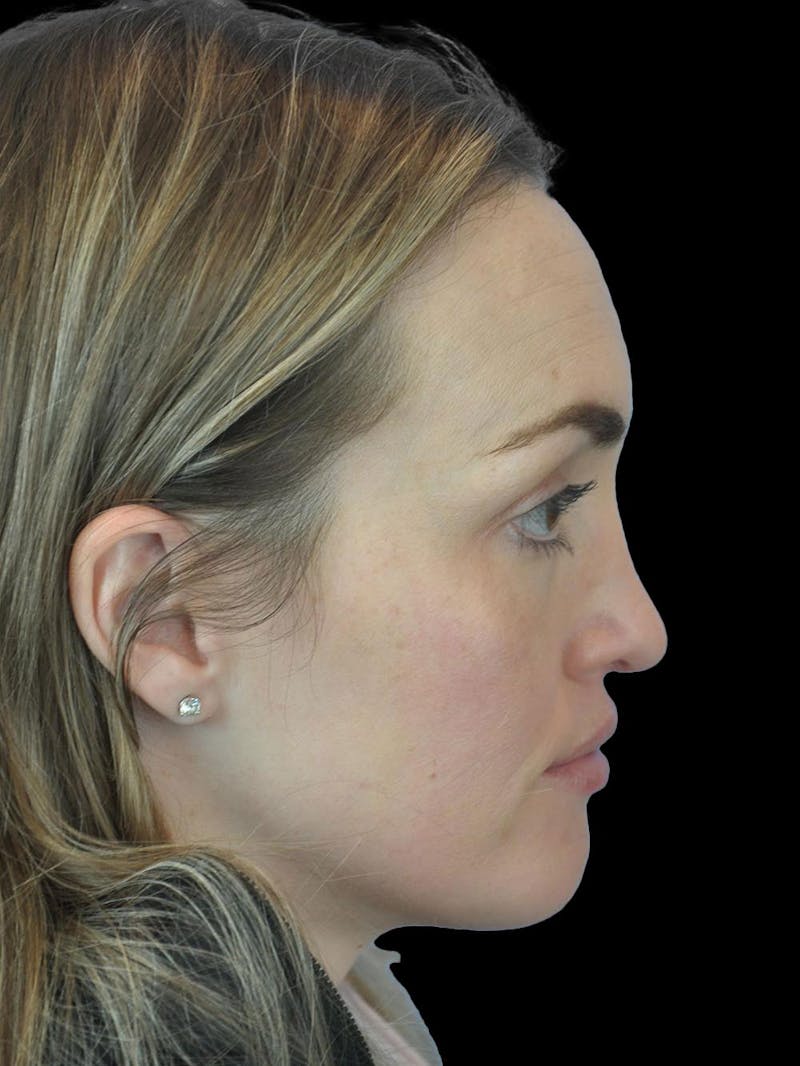 Rhinoplasty Before & After Gallery - Patient 778116 - Image 10