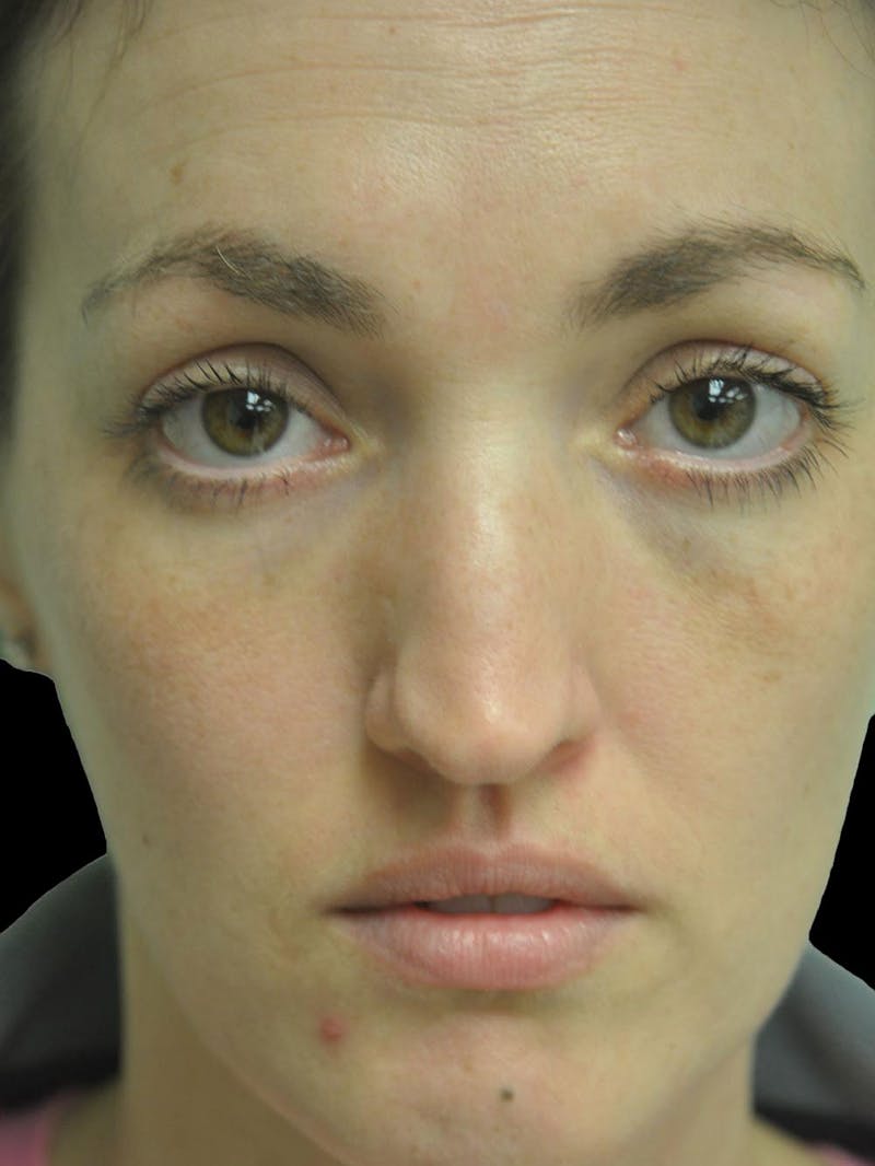 Rhinoplasty Before & After Gallery - Patient 778116 - Image 11