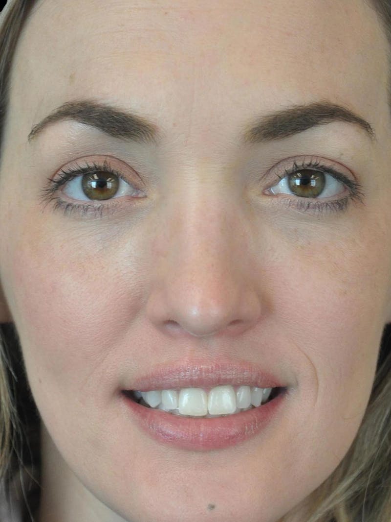 Rhinoplasty Before & After Gallery - Patient 778116 - Image 12