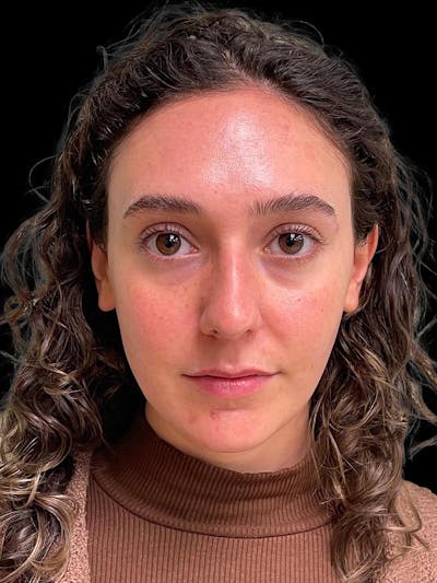 Rhinoplasty Before & After Gallery - Patient 132090 - Image 1