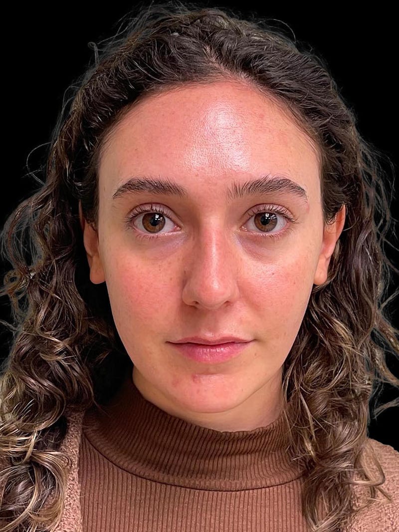 Rhinoplasty Before & After Gallery - Patient 132090 - Image 1
