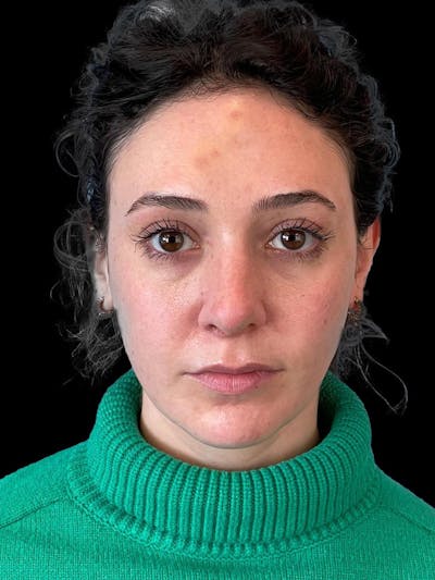 Rhinoplasty Before & After Gallery - Patient 132090 - Image 2