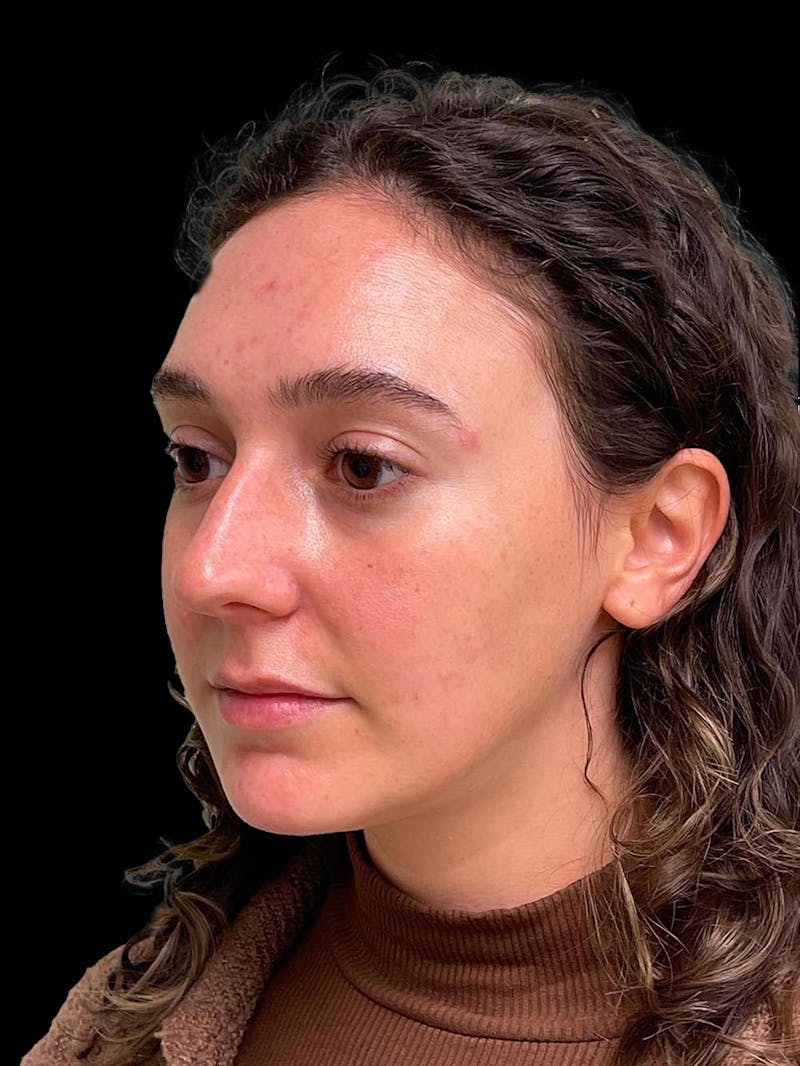 Rhinoplasty Before & After Gallery - Patient 132090 - Image 3