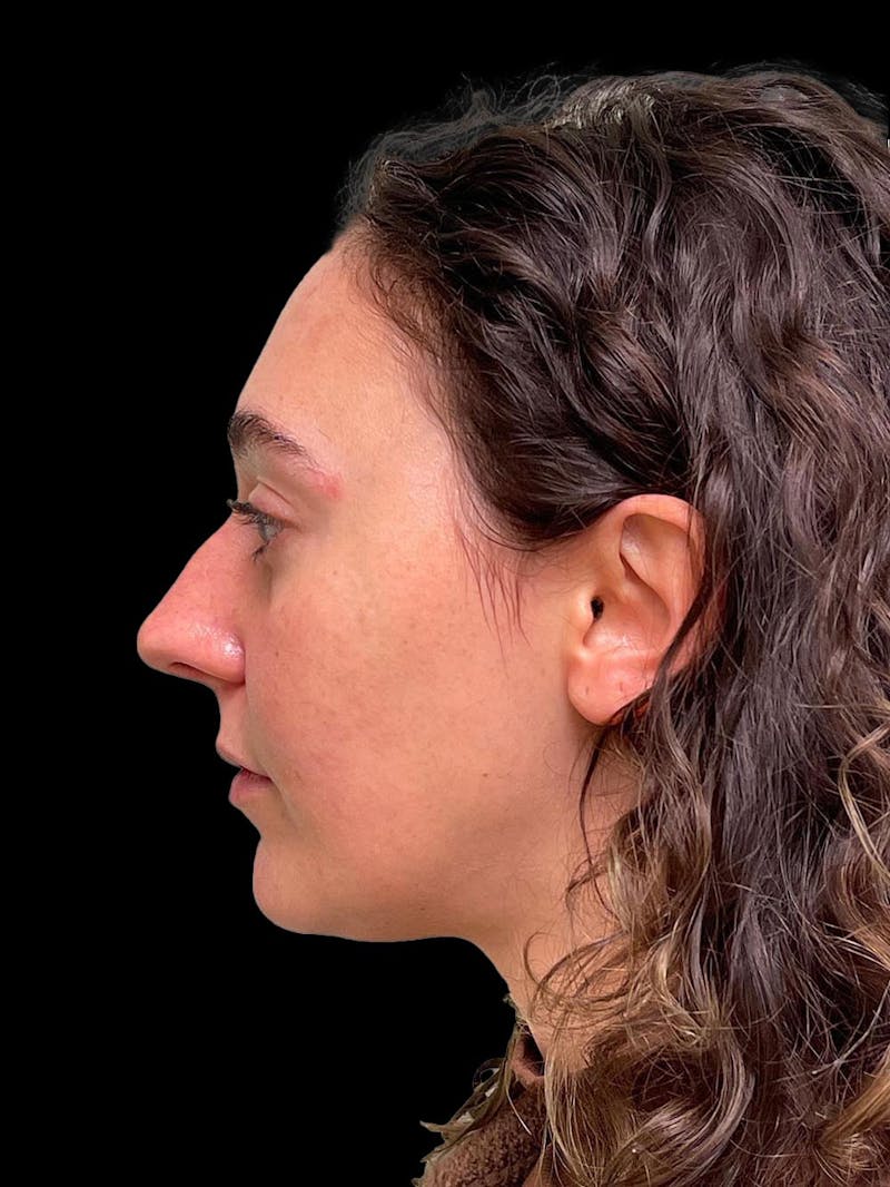 Rhinoplasty Before & After Gallery - Patient 132090 - Image 5