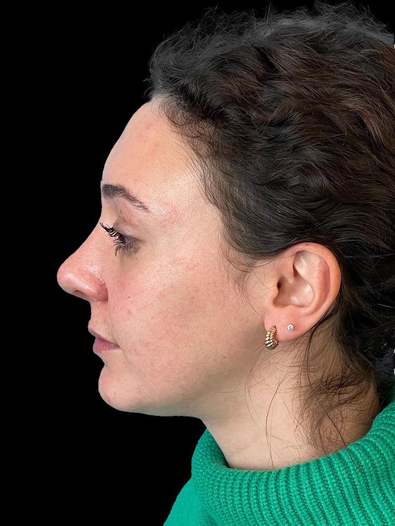 Rhinoplasty Before & After Gallery - Patient 132090 - Image 6