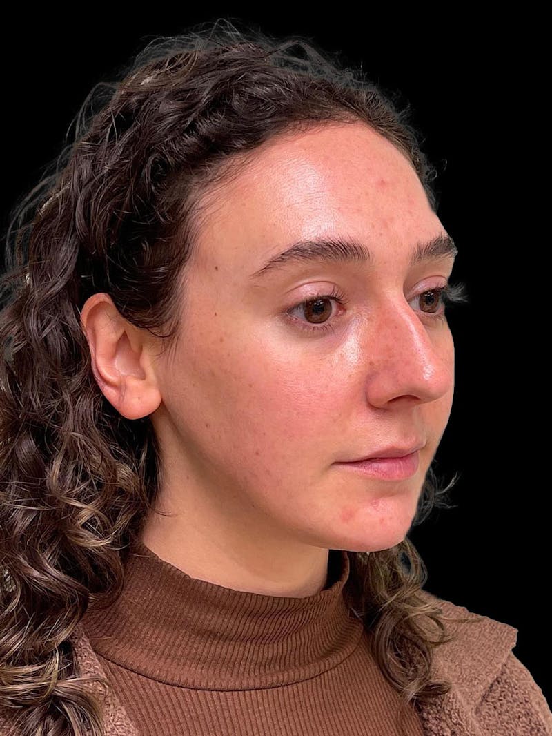 Rhinoplasty Before & After Gallery - Patient 132090 - Image 7