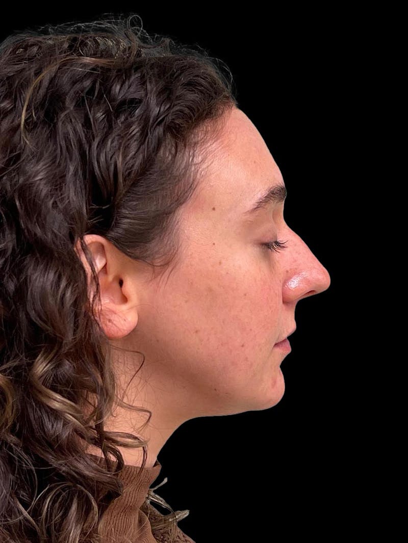 Rhinoplasty Before & After Gallery - Patient 132090 - Image 9