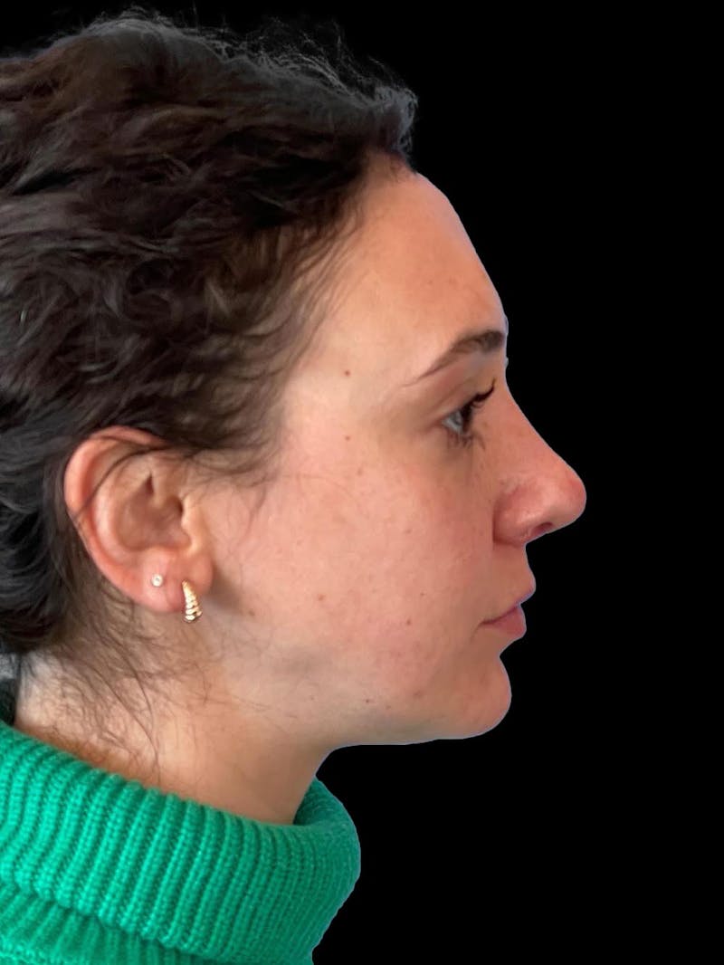 Rhinoplasty Before & After Gallery - Patient 132090 - Image 10