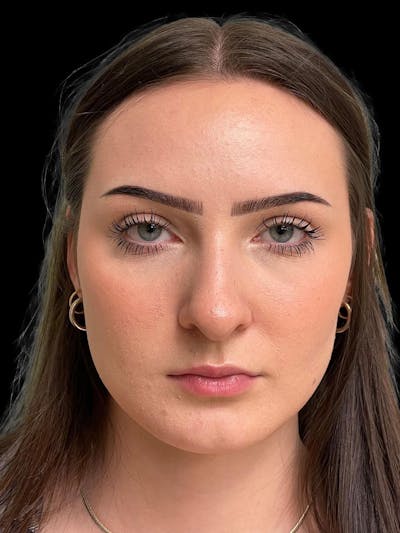 Rhinoplasty Before & After Gallery - Patient 413066 - Image 1