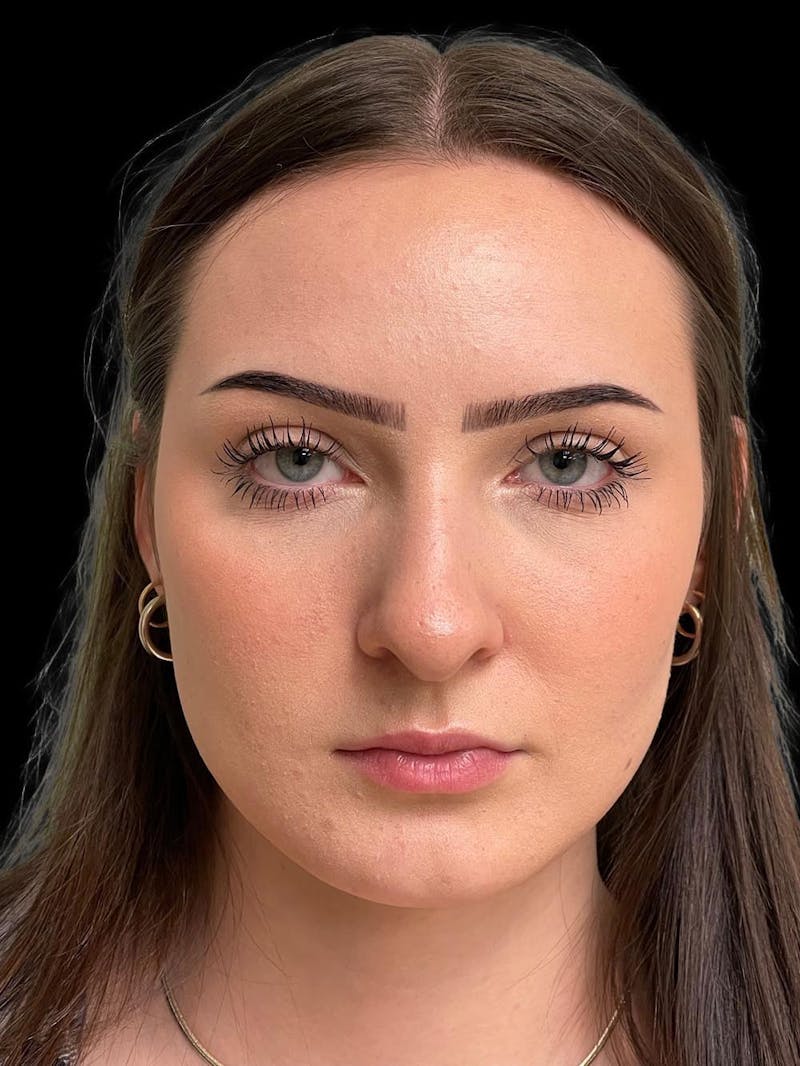 Rhinoplasty Before & After Gallery - Patient 413066 - Image 1