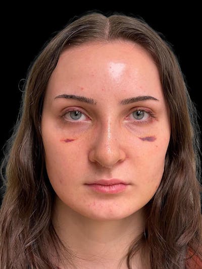 Rhinoplasty Before & After Gallery - Patient 413066 - Image 2