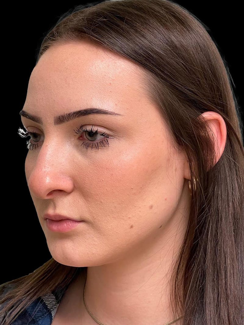 Rhinoplasty Before & After Gallery - Patient 413066 - Image 3