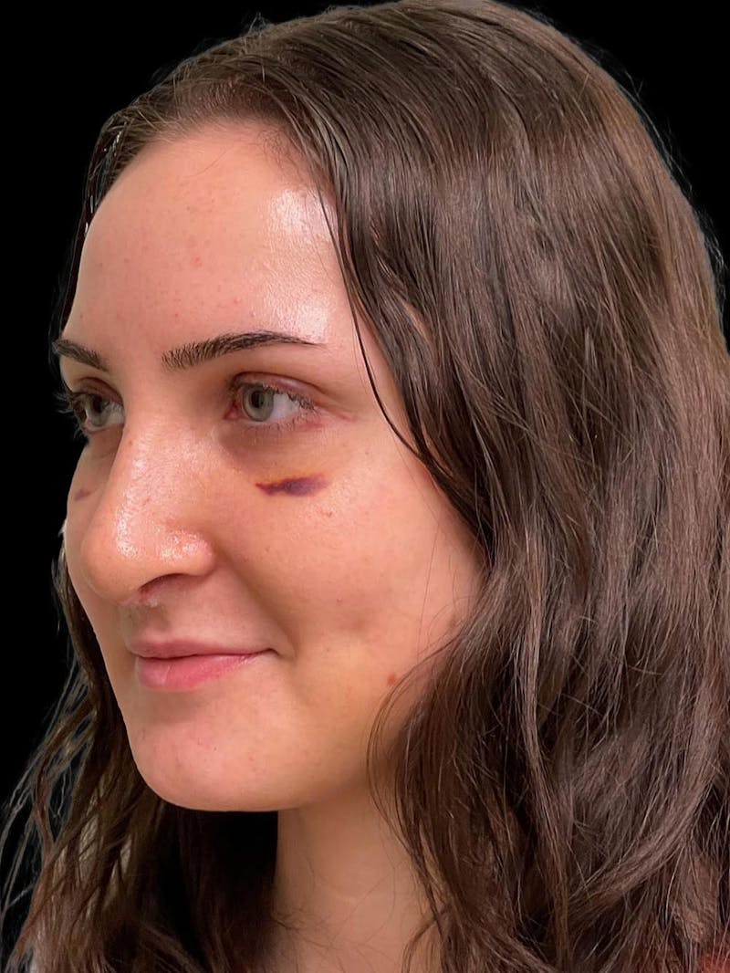Rhinoplasty Before & After Gallery - Patient 413066 - Image 4