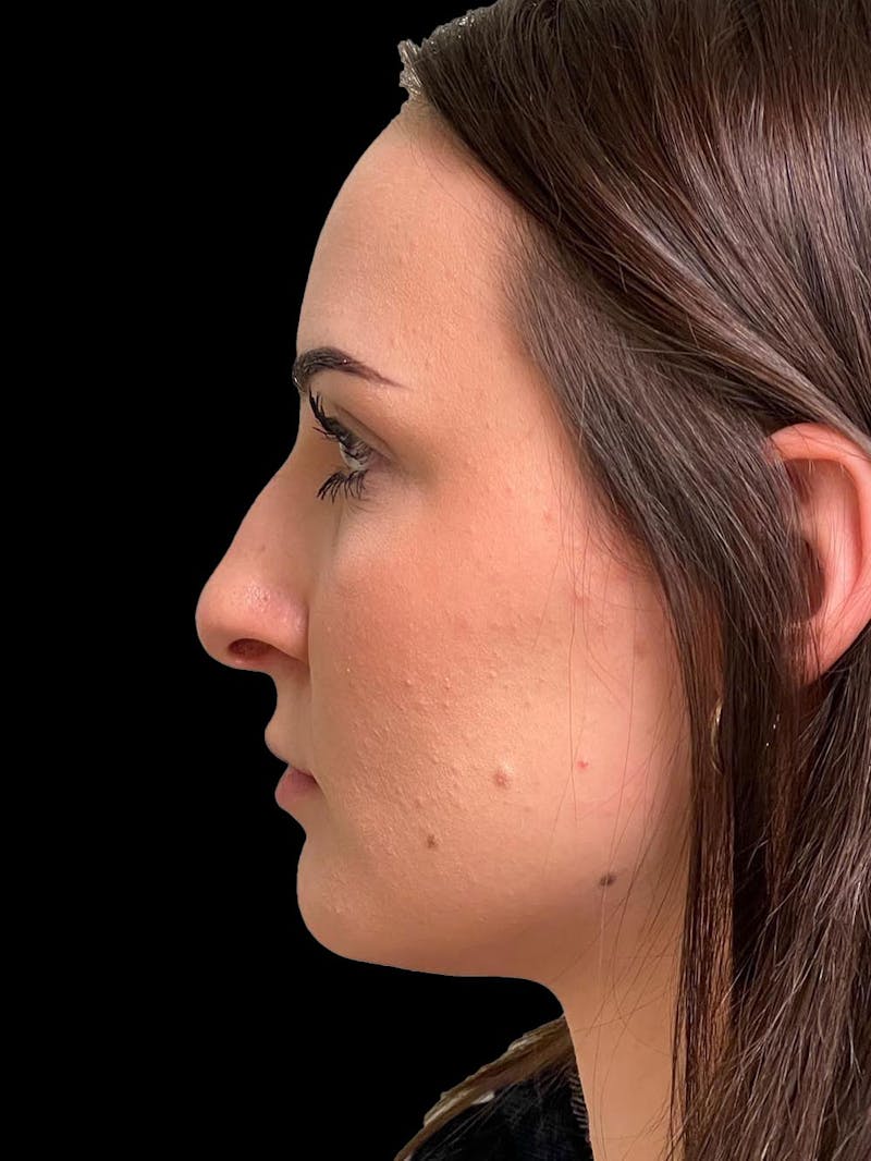 Rhinoplasty Before & After Gallery - Patient 413066 - Image 5