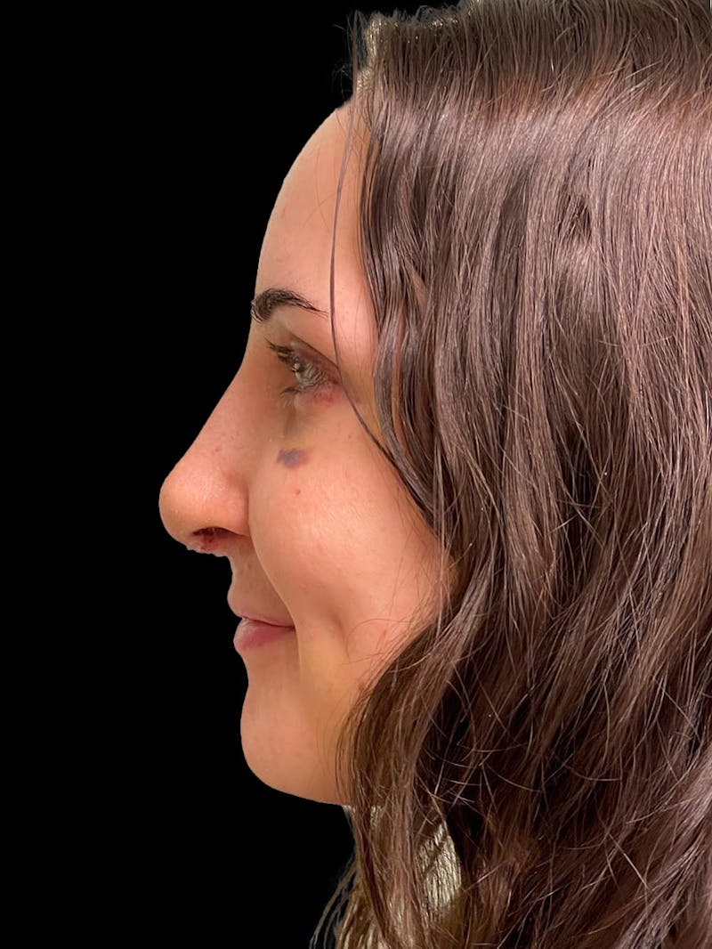 Rhinoplasty Before & After Gallery - Patient 413066 - Image 6