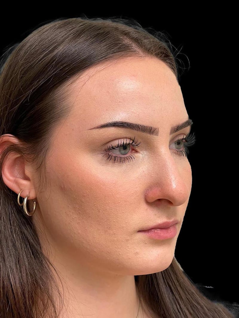 Rhinoplasty Before & After Gallery - Patient 413066 - Image 7