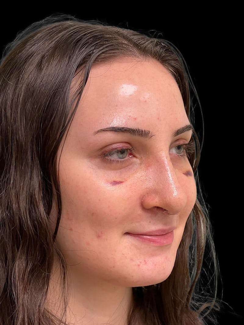 Rhinoplasty Before & After Gallery - Patient 413066 - Image 8