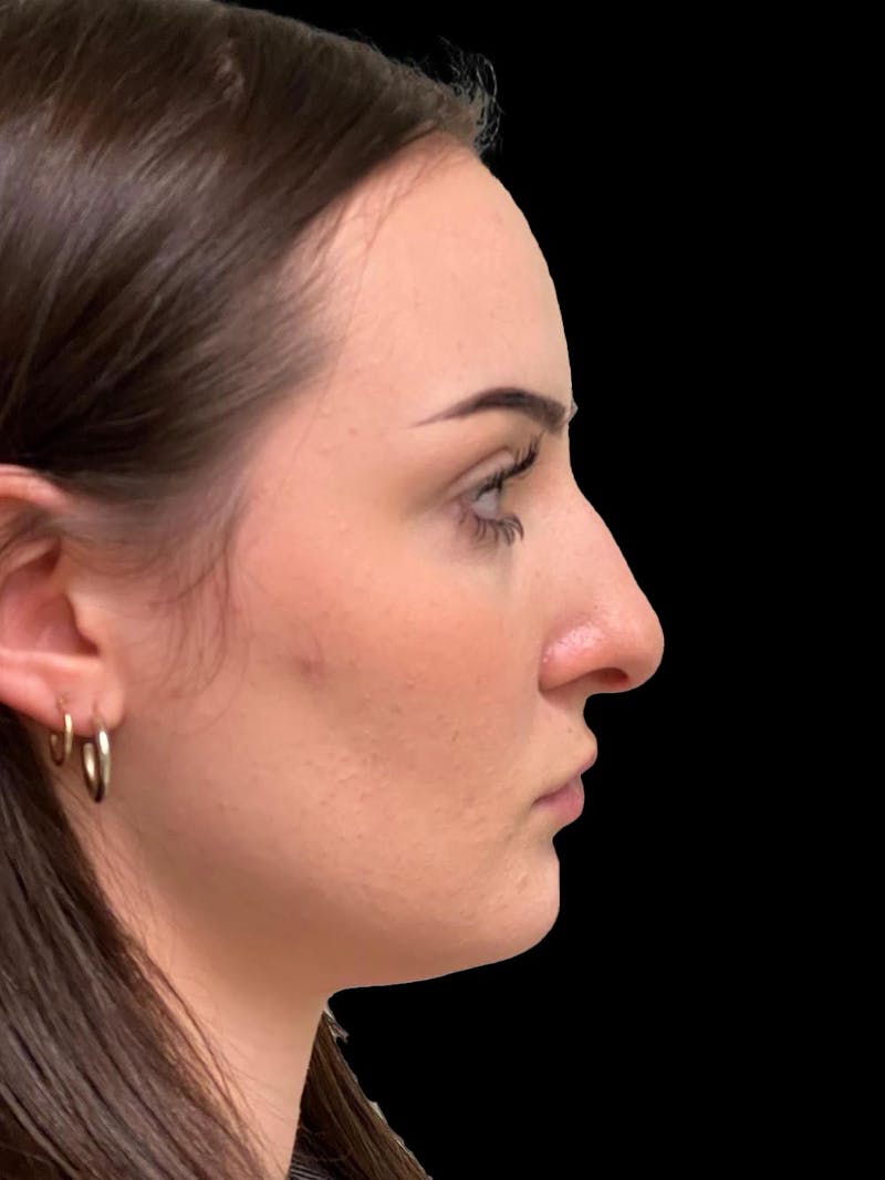 Rhinoplasty Before & After Gallery - Patient 413066 - Image 9