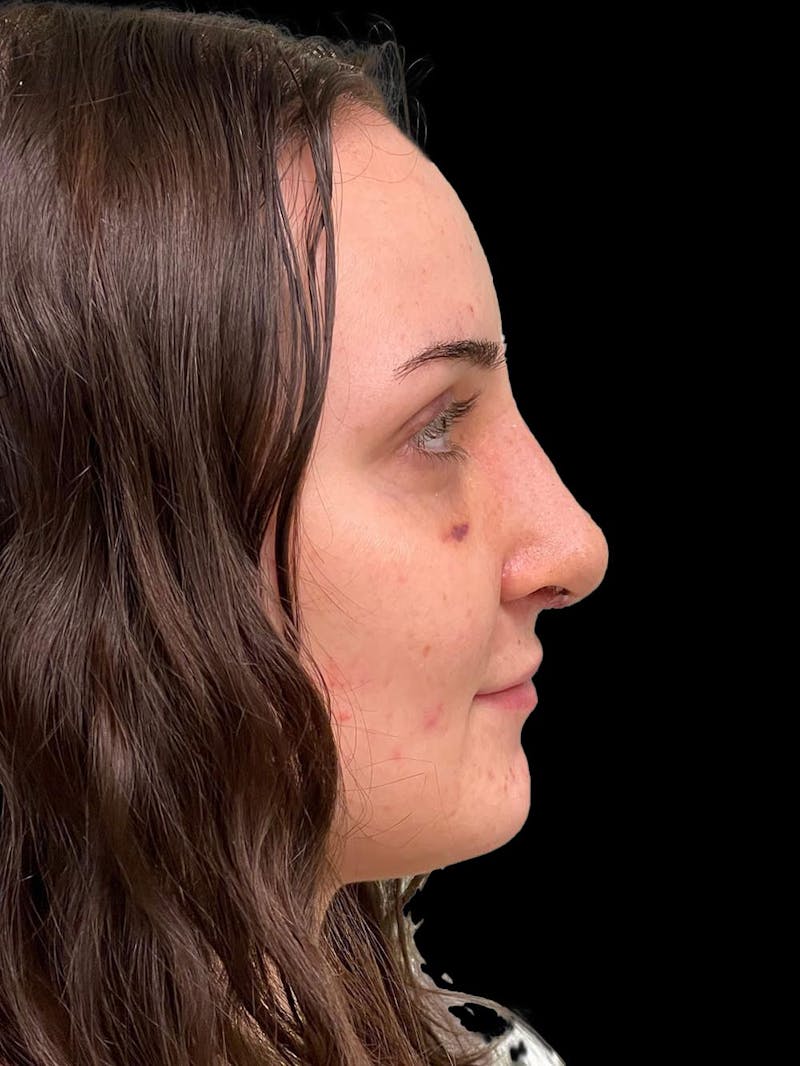 Rhinoplasty Before & After Gallery - Patient 413066 - Image 10