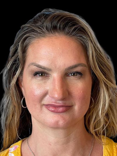 Rhinoplasty Before & After Gallery - Patient 312743 - Image 1