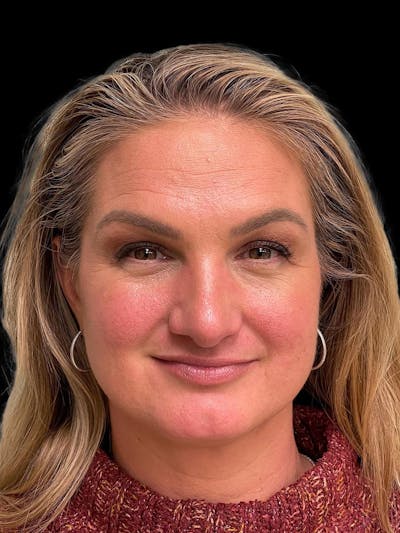 Rhinoplasty Before & After Gallery - Patient 312743 - Image 2