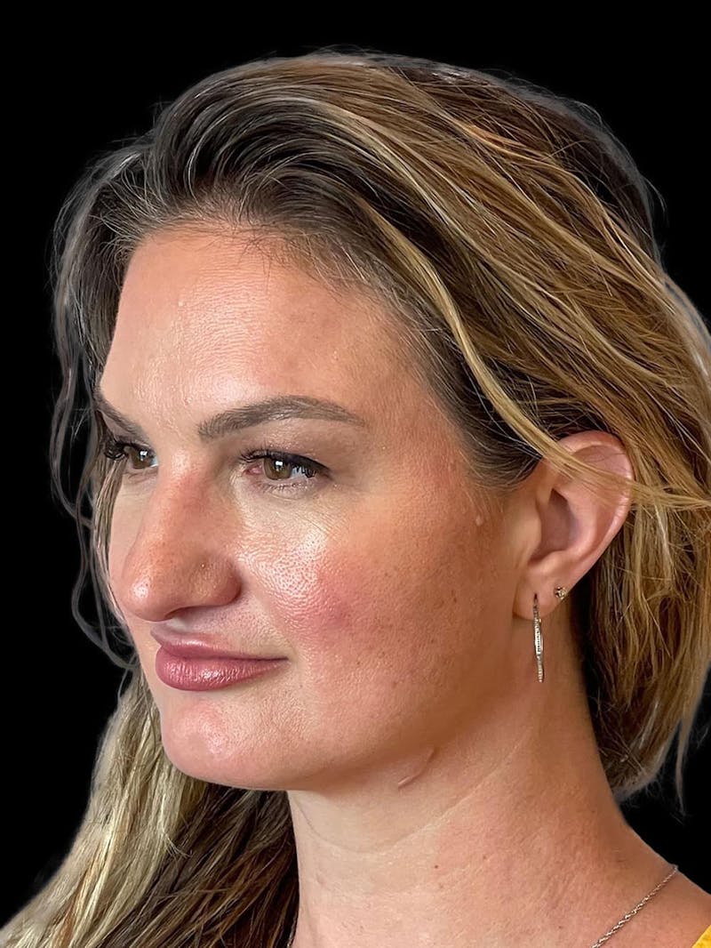 Rhinoplasty Before & After Gallery - Patient 312743 - Image 3