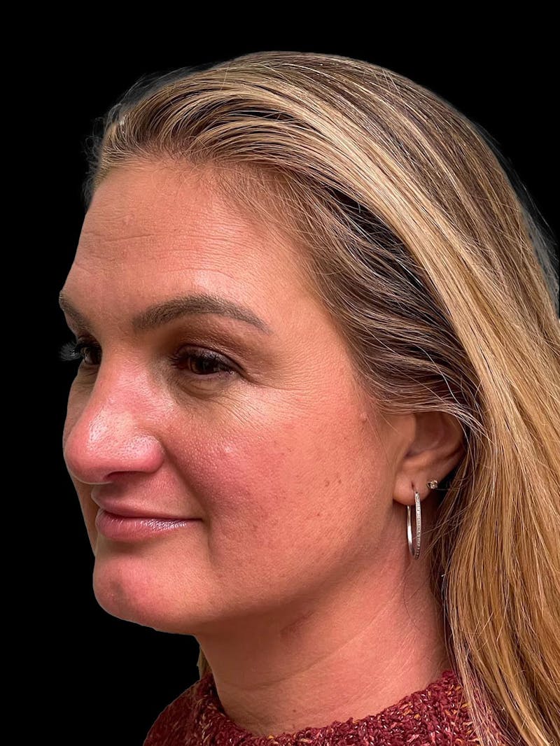 Rhinoplasty Before & After Gallery - Patient 312743 - Image 4