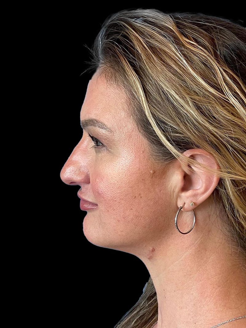 Rhinoplasty Before & After Gallery - Patient 312743 - Image 5