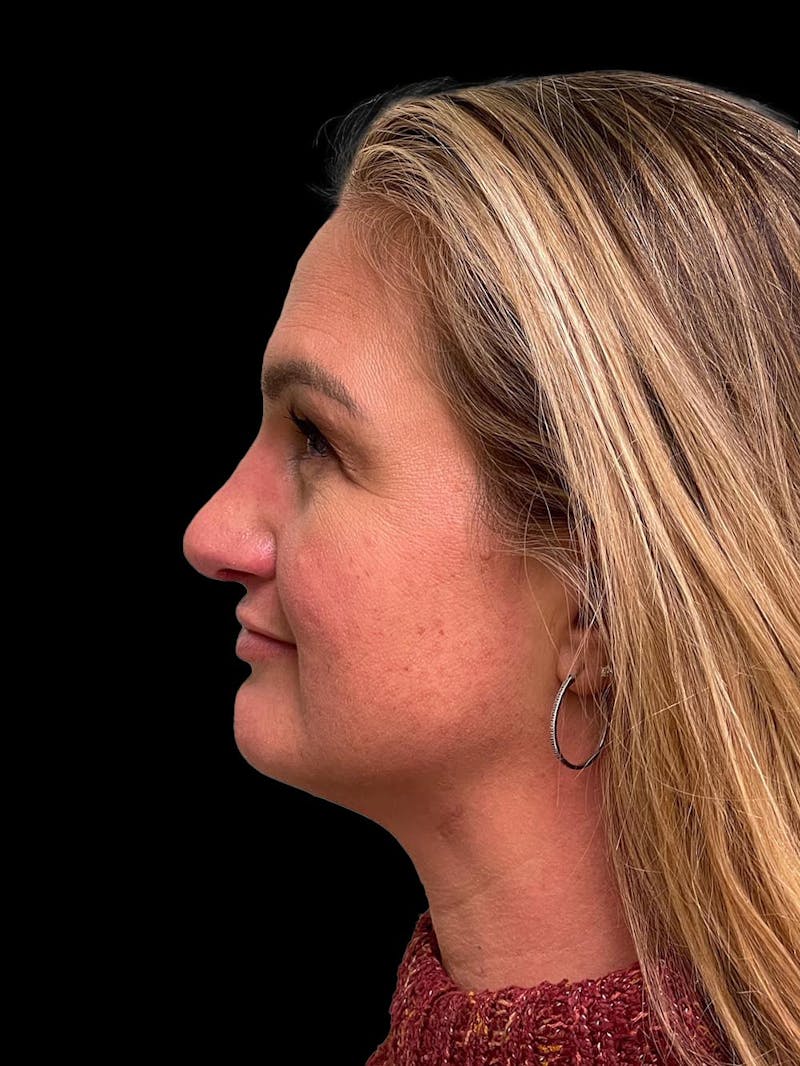 Rhinoplasty Before & After Gallery - Patient 312743 - Image 6