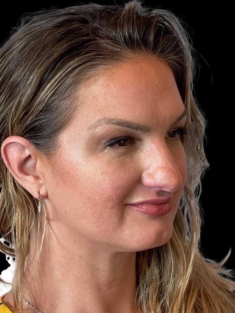 Rhinoplasty Before & After Gallery - Patient 312743 - Image 7