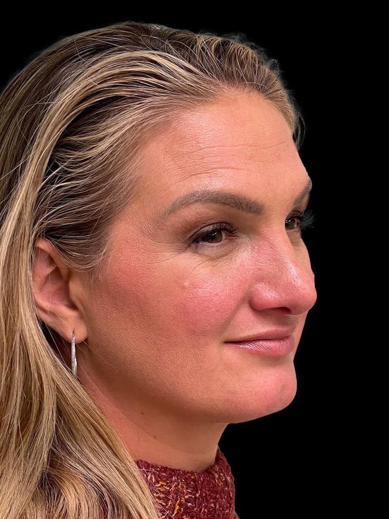 Rhinoplasty Before & After Gallery - Patient 312743 - Image 8