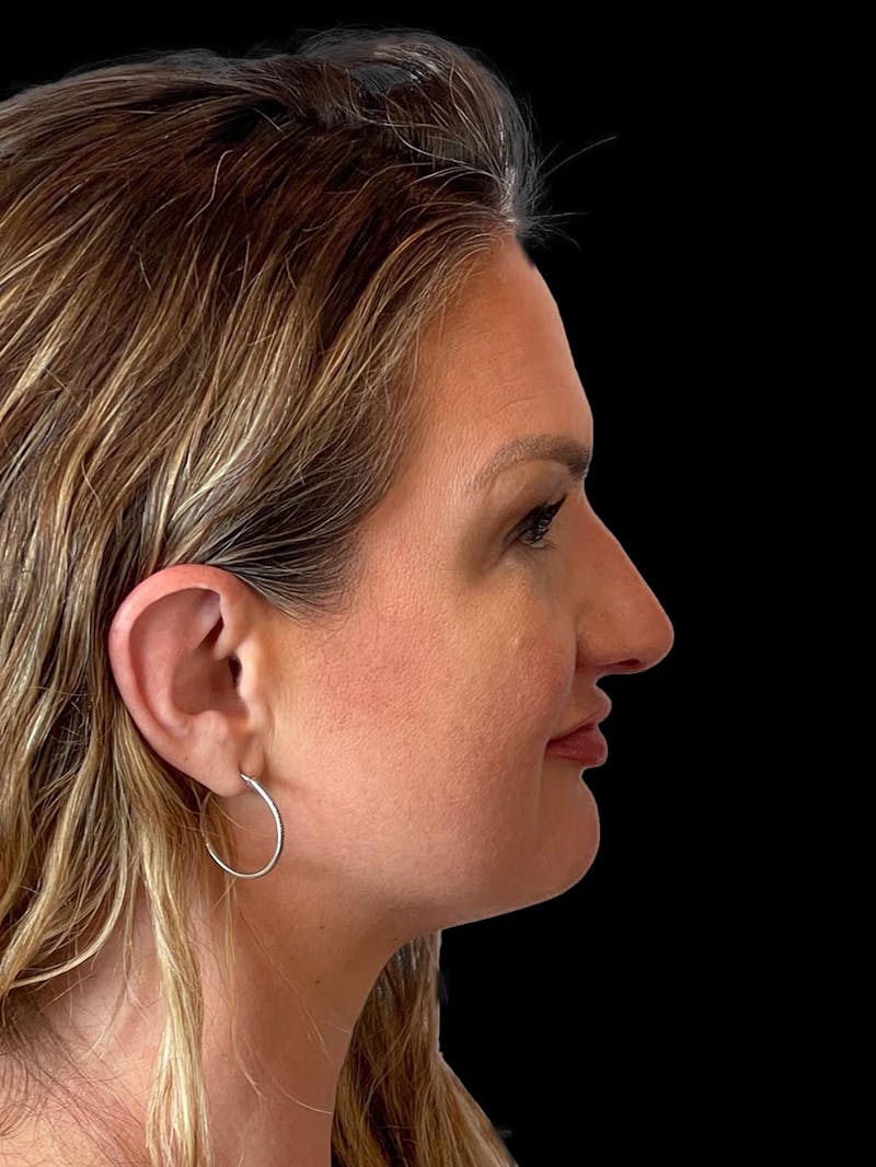 Rhinoplasty Before & After Gallery - Patient 312743 - Image 9