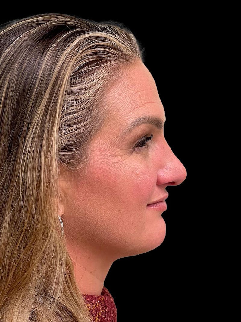 Rhinoplasty Before & After Gallery - Patient 312743 - Image 10