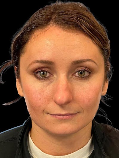 Rhinoplasty Before & After Gallery - Patient 195708 - Image 1