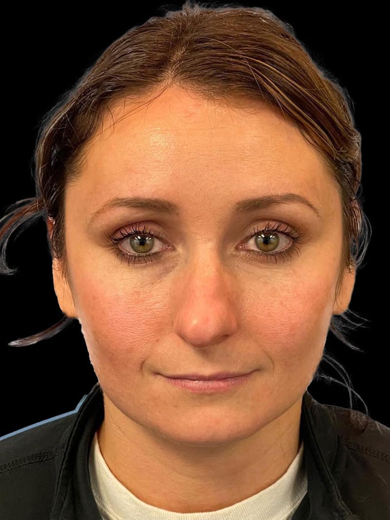 Rhinoplasty Before & After Gallery - Patient 195708 - Image 1