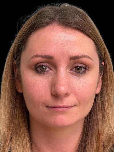 Rhinoplasty Before & After Gallery - Patient 195708 - Image 2