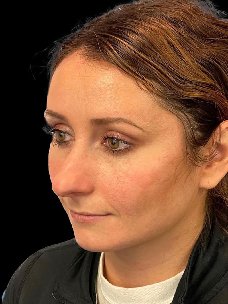 Rhinoplasty Before & After Gallery - Patient 195708 - Image 3
