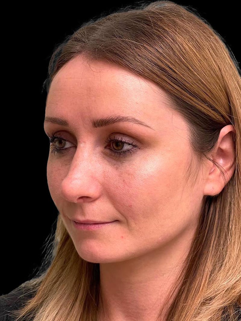 Rhinoplasty Before & After Gallery - Patient 195708 - Image 4
