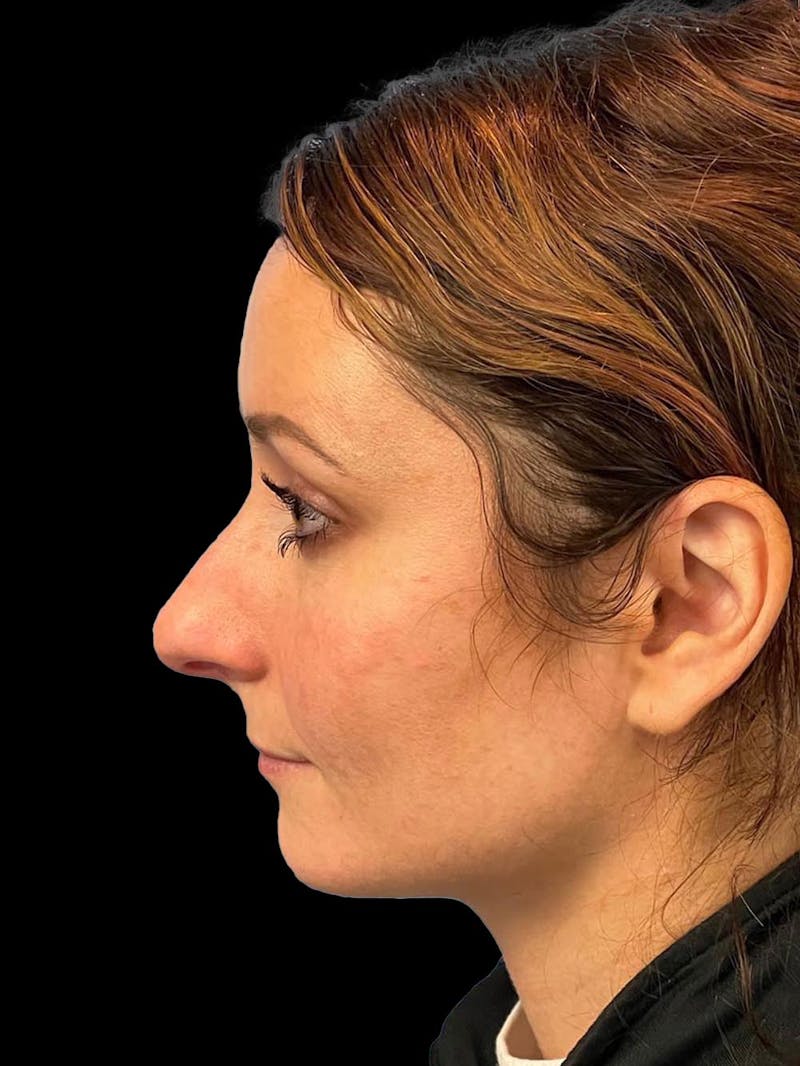 Rhinoplasty Before & After Gallery - Patient 195708 - Image 5