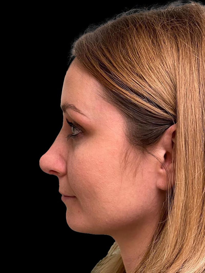 Rhinoplasty Before & After Gallery - Patient 195708 - Image 6