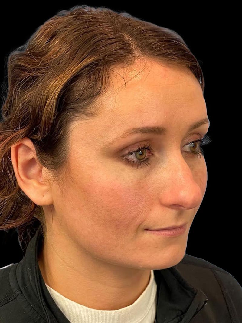 Rhinoplasty Before & After Gallery - Patient 195708 - Image 7