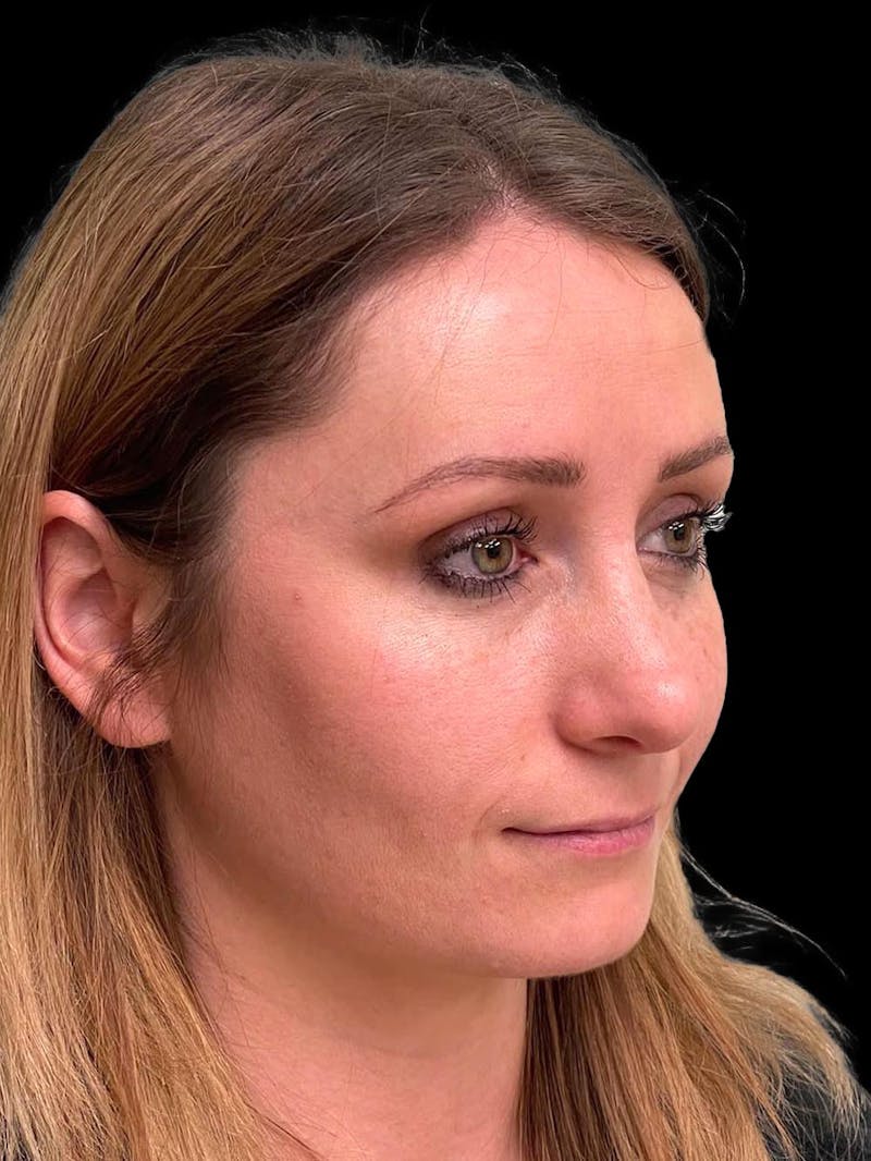 Rhinoplasty Before & After Gallery - Patient 195708 - Image 8
