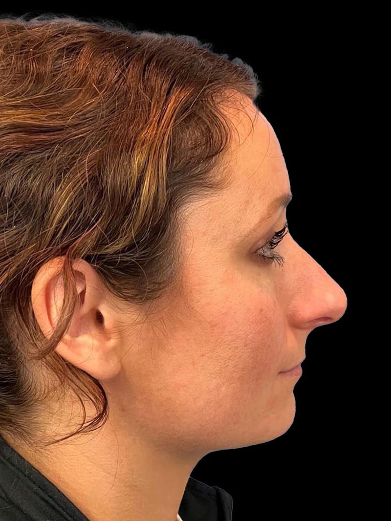 Rhinoplasty Before & After Gallery - Patient 195708 - Image 9
