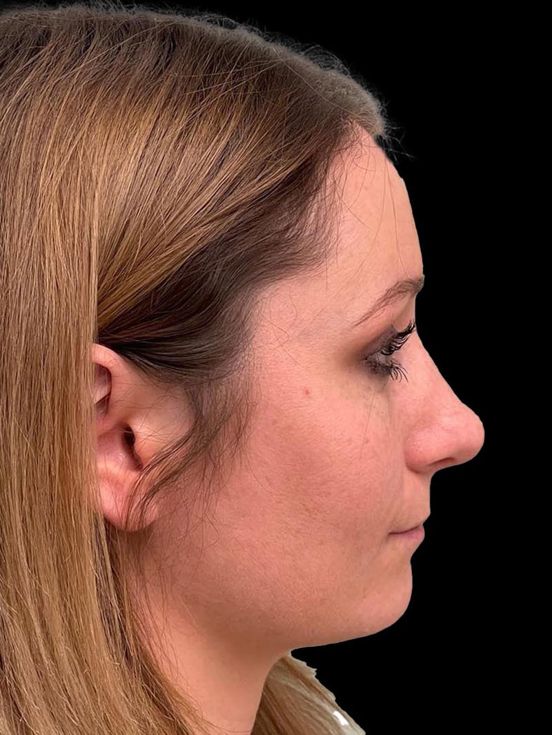 Rhinoplasty Before & After Gallery - Patient 195708 - Image 10