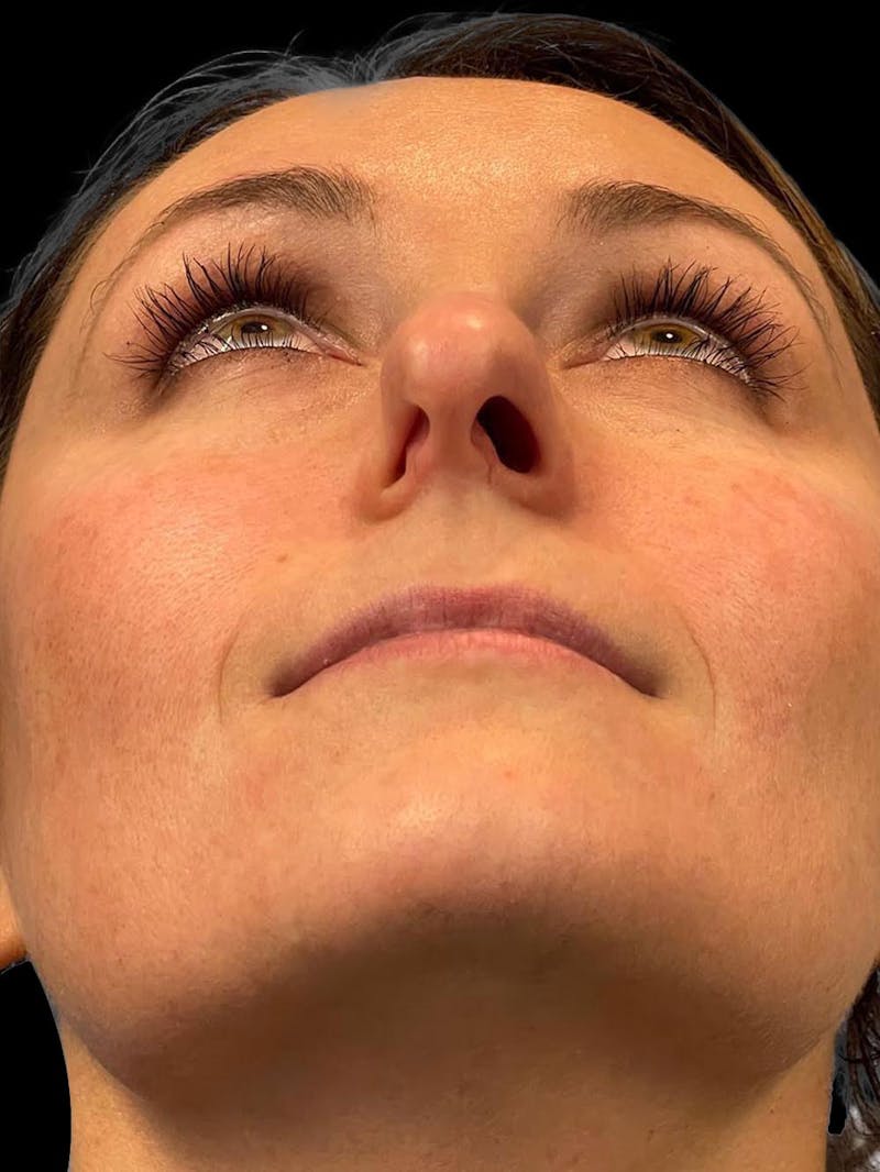 Rhinoplasty Before & After Gallery - Patient 195708 - Image 11