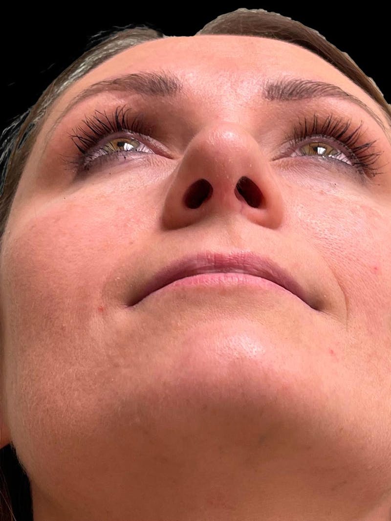 Rhinoplasty Before & After Gallery - Patient 195708 - Image 12
