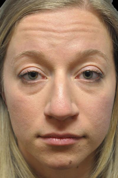 Rhinoplasty Before & After Gallery - Patient 232491 - Image 1